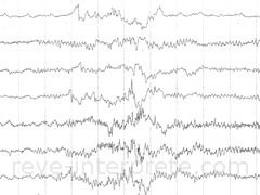 reve d'epilepsie - interpretation des reves